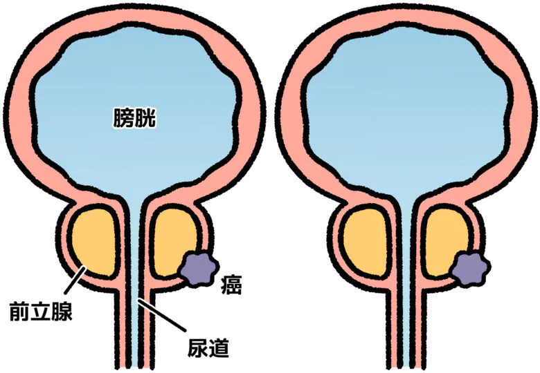 前立腺がん