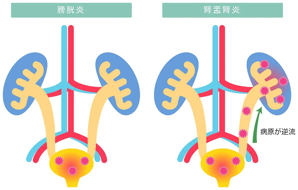 膀胱炎